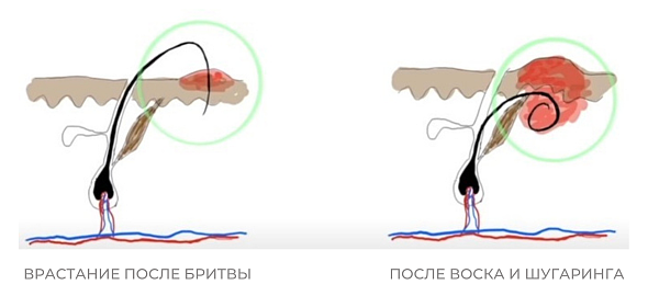 Почему врастают волосы в зоне бикини после бритья и воска