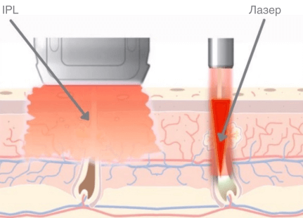 В чем разница между лазерной эпиляцией и фотоэпиляцией