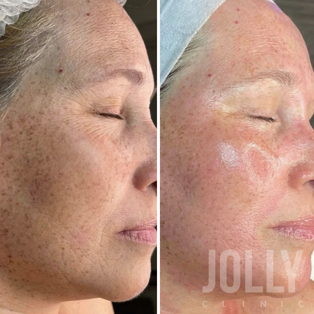 Эффект после плазмолифтинга фото до и после