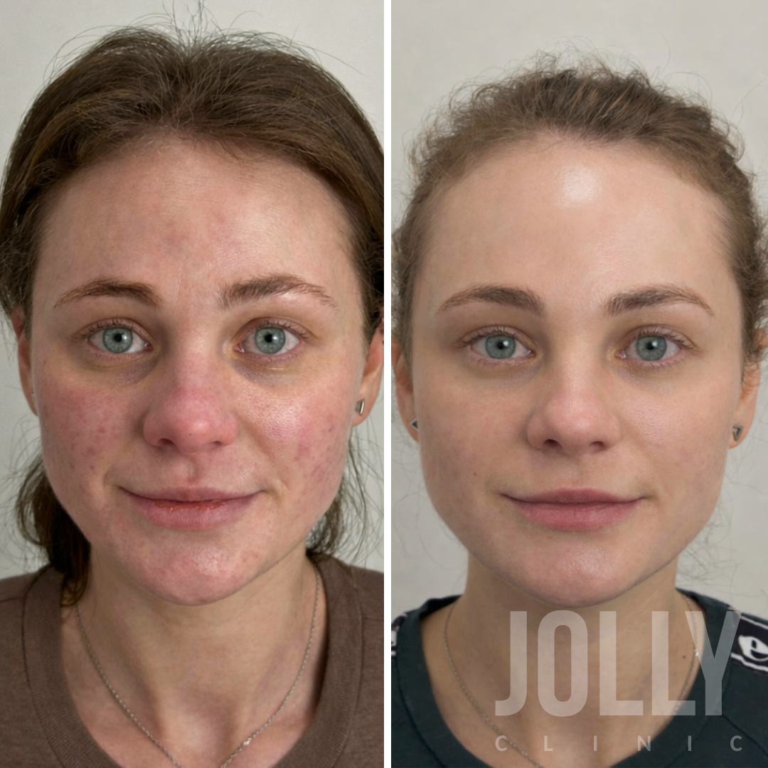 Плазмотерапия ПРП после акне, результат фото до и после