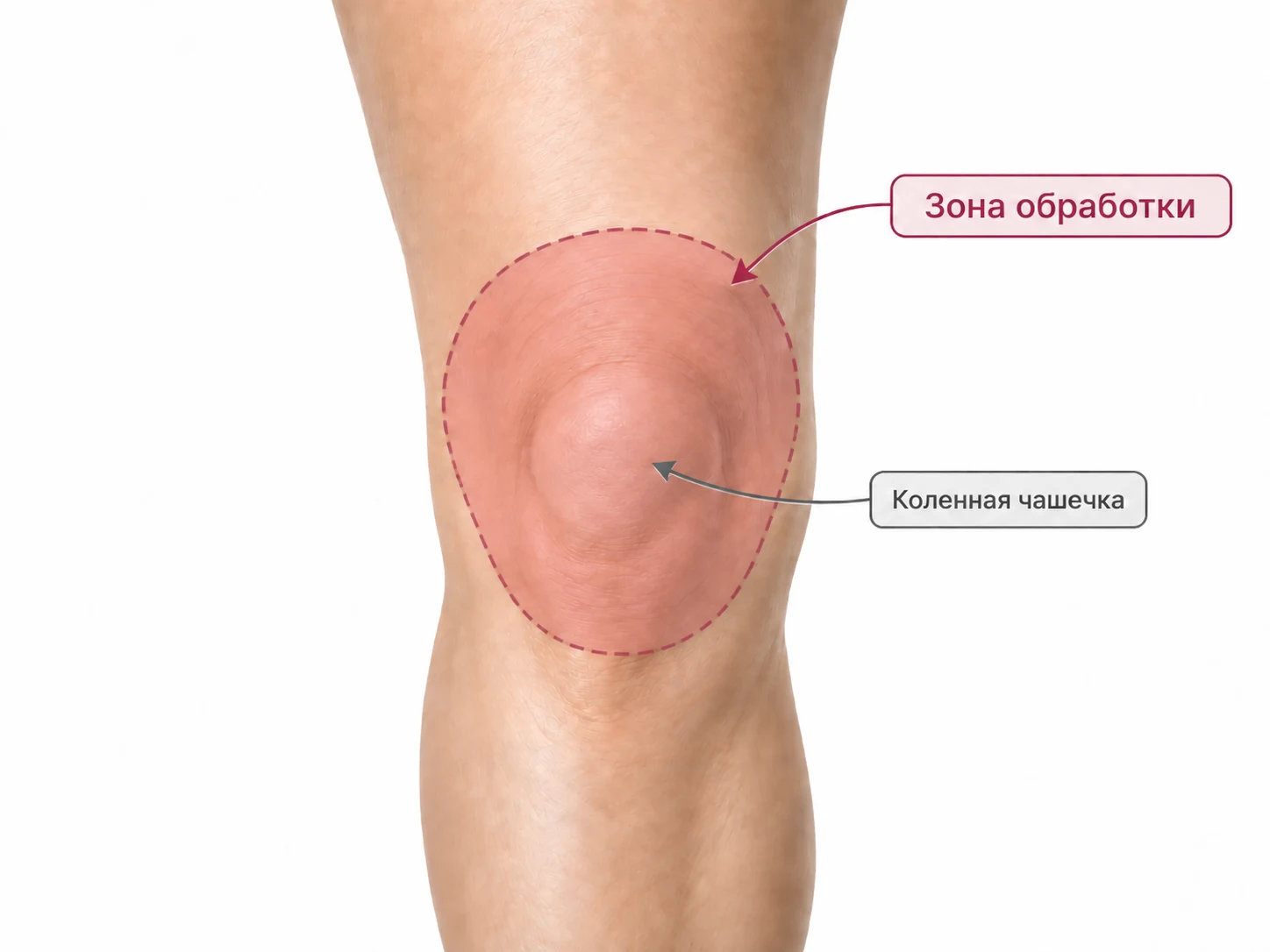 Зона обработки во время игольчатого РФ коленей