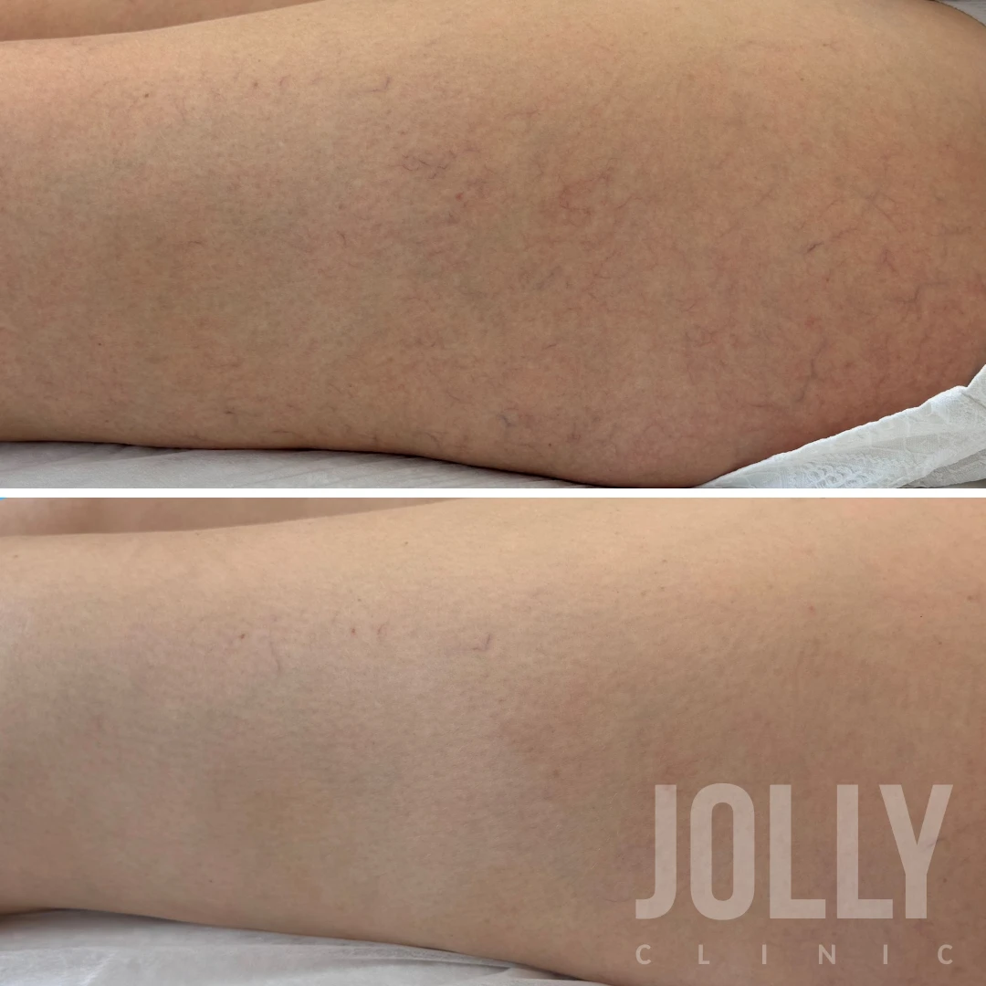 Фото до и после удаления сосудов на ногах лазером, 2 процедуры Derma V
